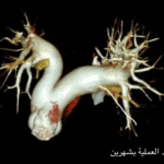 إعادة بناء ثلاثية الأبعاد للشرايين الرئوية بعد العلاج بشهرين