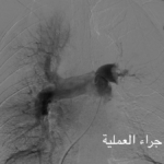 صورة وعائية للشرايين الرئوية ملتقطة خلال الإجراء التداخلي