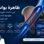إنفوجرافيك يوضح تأثير بواسون في دعامة الوريد الحرقفي