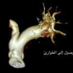 إعادة بناء ثلاثية الأبعاد للشرايين الرئوية عند الوصول إلى الطوارئ