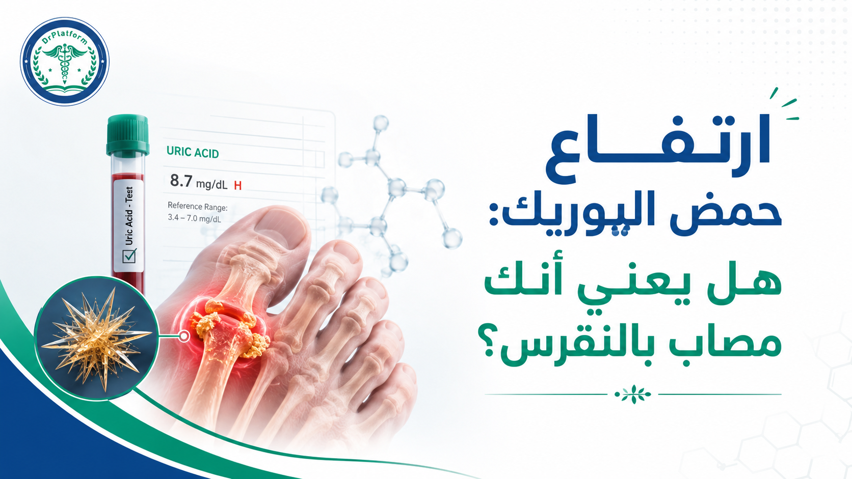ارتفاع حمض اليوريك وعلاقته بالنقرس وترسب بلورات اليورات