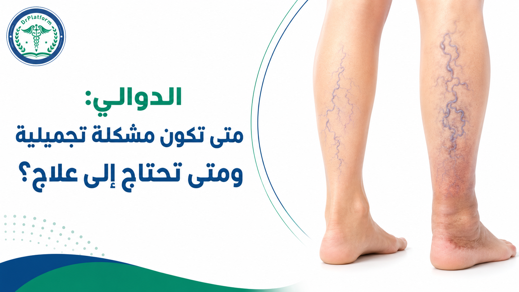 الدوالي وأعراضها وطرق علاجها